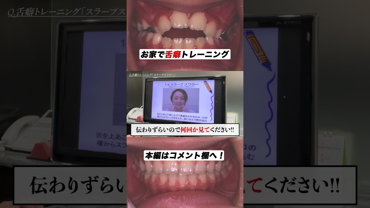 MFT】開咬を治すなら舌癖トレーニング#shorts - YouTube