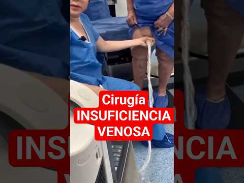 Ablasion de Venas Varicosas por Radiofrecuencia - Cirugía Várices