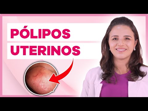 Pólipo endometrial é perigoso? (Vídeo com Retirada de Pólipo)