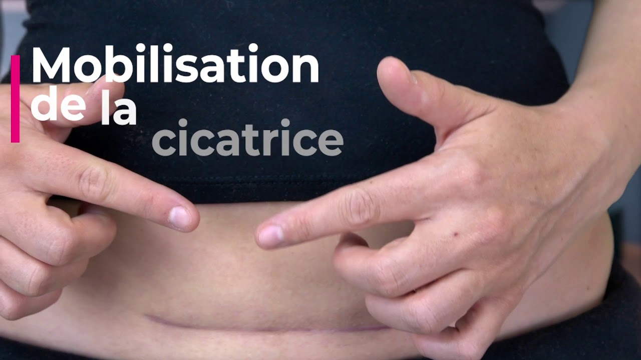 Automassage de votre cicatrice de césarienne / 5 techniques de massage en  temps réel Kiné Postpartum - YouTube