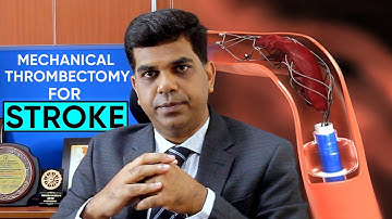 Mechanical Thrombectomy - Brain Stroke Treatment |Dr. Srinivasan Paramasivam