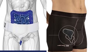 $50 Amazon Hernia Belt VS $150 Hernia Compression Shorts Review/Comparison After 1 Year of Use
