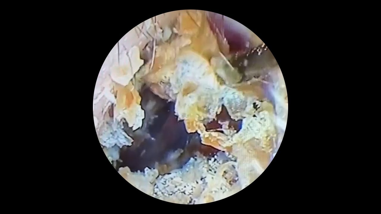 Relax Everyday With Satisfying Ear Wax Removal