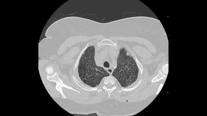 Pulmonary Langerhans cell histiocytosis (PLCH) on CT