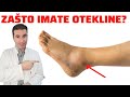 Što Uzrokuje OTEKLINE NOGU NOŽNIH ZGLOBOVA I STOPALA Što Uzrokuje OTEKLINE NOGU NOŽNIH ZGLOBOVA I STOPALA