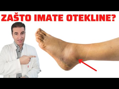 Video: Šta uzrokuje nestabilnost stopala?