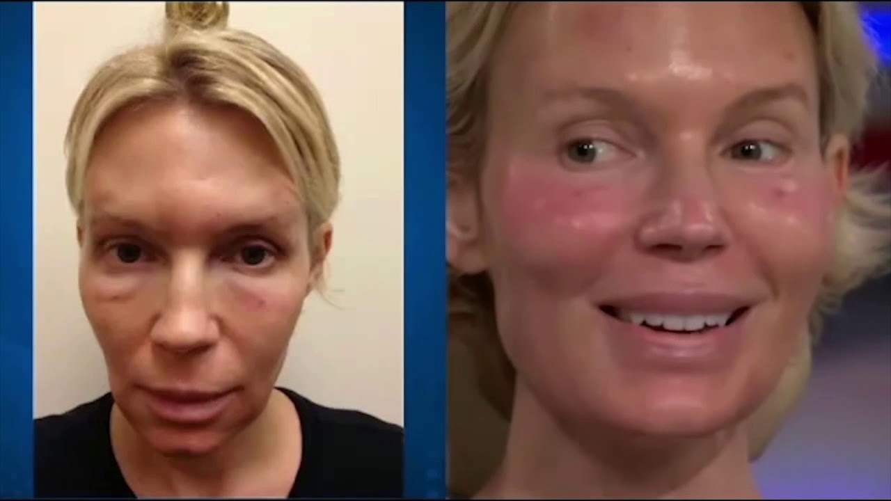 Forma - Skin Tightening - YouTube