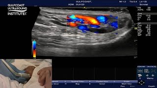 Hot Tips - Testicular Ultrasound for Varicocele