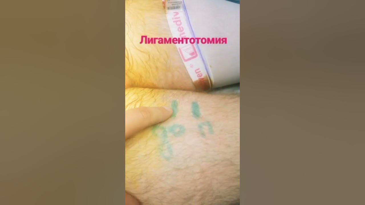 Лигаментотомия - хирургическое увеличение длины пениса. - НУП