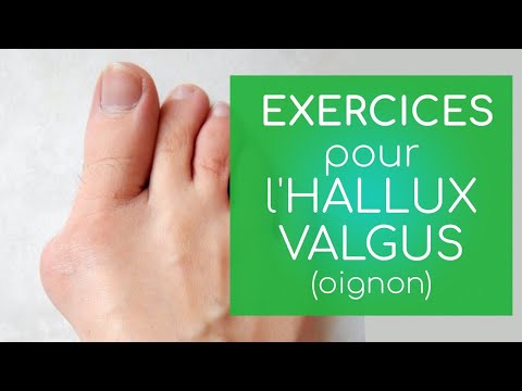 Vidéo: Hallux Valgus Du Pied Et Des Orteils - Traitement