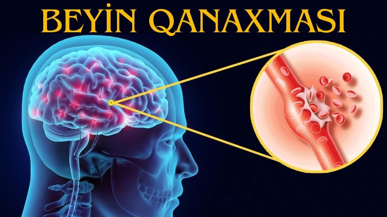 Ürəkbulanma, Baş ağrısı... | BEYİN QANSIZMASI OLA BİLƏR! #neyrocerrah #beyincerrahı #onurgacerrahı