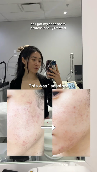 First impressions of Picoway Laser 🚨 #laser #facial #acne