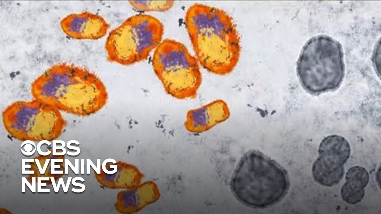 Over 7,000 Monkeypox cases reported in U.S. - YouTube