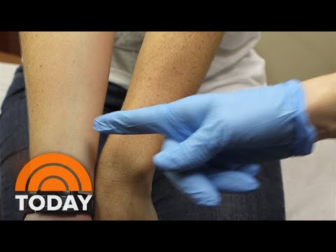 Video: Kun je meerdere melanomen tegelijk hebben?
