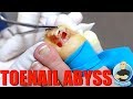 RELEASING A POCKET OF INFECTION IN A TOENAIL