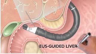 EUS-guided liver biopsy