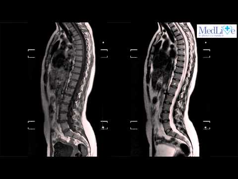 Video: RMN și Radiografie în Spondiloartrita Axială: Relația Dintre Modificările Inflamatorii și Structurale