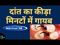दांतों से कीड़ा हटाएं || Daanto se Keeda hataye || #Toothdecay
