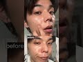 썸남썸녀 하얀 각질이랑 피지보면 어떰??? 히스트 #트러블면봉 #트러블필링스왑