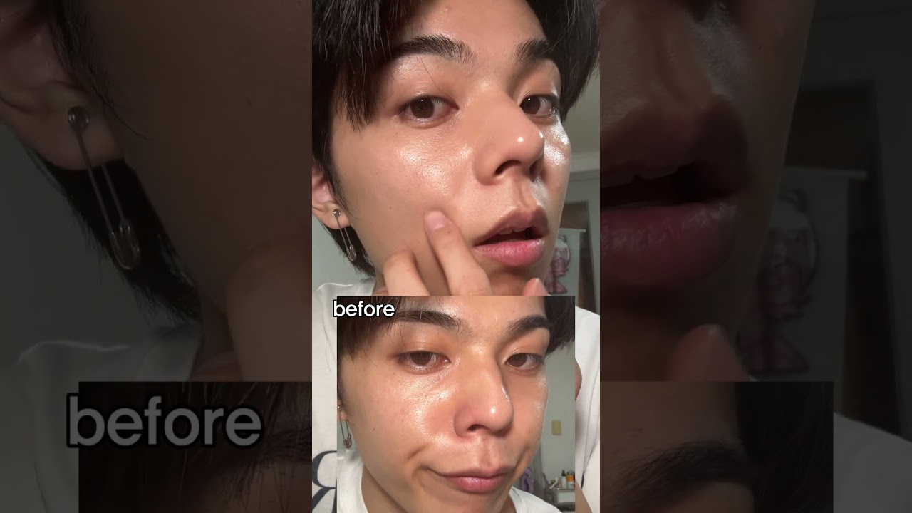 썸남썸녀 하얀 각질이랑 피지보면 어떰??? 히스트 #트러블면봉 #트러블필링스왑