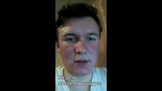 Дневник после лазерной шлифовки кожи лица. Отзыв. видео Лазерная косметология