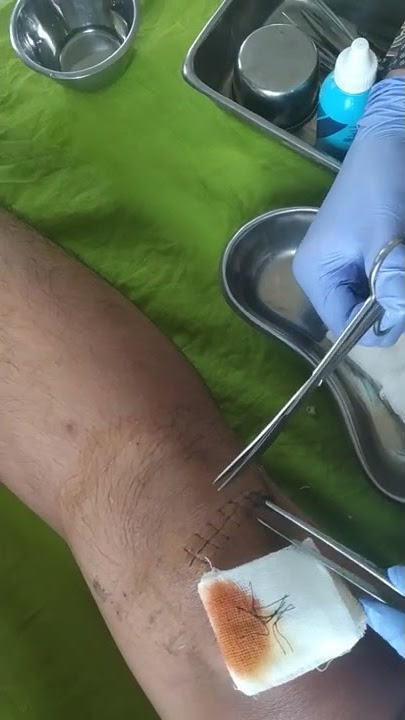 BUKA 10 JAHITAN DI LUTUT