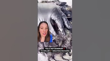 Thumbnail of Seborrheic Dermatitis Vs. Dandruff