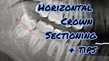 Mesioangular Wisdom Tooth Extraction Step-by-Step @drwahan