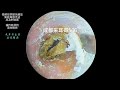 采耳哥 Clean Dry Fungal Slices In The Ear 566 Asmr Earwax Earwaxremoval Drzhao 采耳哥 Clean Dry Fungal Slices In The Ear 566 Asmr Earwax Earwaxremoval Drzhao