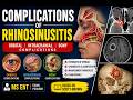 Complications of Rhinosinusitis | Orbital, Intracranial & Bony Complications | MS ENT