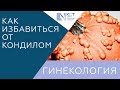 Лечение кондилом. Кондиломы