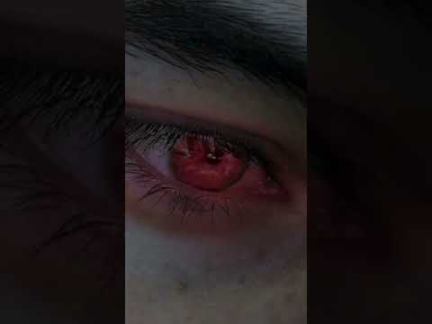 كيف الكسوف يخليك أعمى