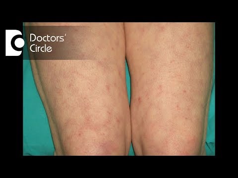 Purple lace type of discoloration on lower extremities signify Livedo Reticularis - Dr. Nischal K
