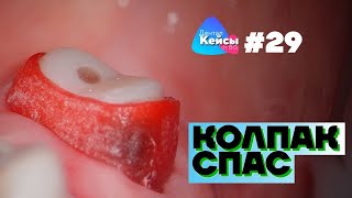 видео: Колпак спас | Дентал Кейсы от BG #29 картинка: Колпак спас | Дентал Кейсы от BG #29