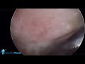 ROTATOR CUFF ARTHROSCOPIC REINFORCEMENT FOR THE MANAGEMENT OF INTRASUBSTANCE TEARS