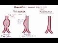 Aneurysms - causes, symptoms, diagnosis, treatment, pathology