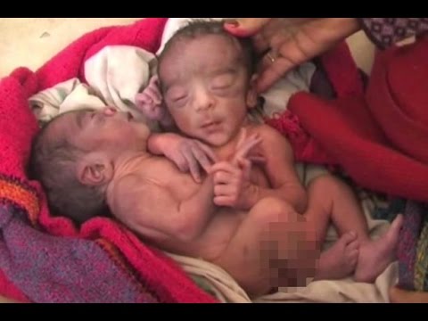 The parents of conjoined twins have vowed to give their babies the best cha...