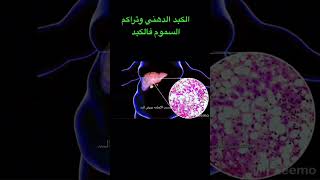 ازاي تتخلص من  الكبد الدهني وتراكم السموم ومقاومة الانسولين(دكتور محمد نوار ٢٠٢٣)