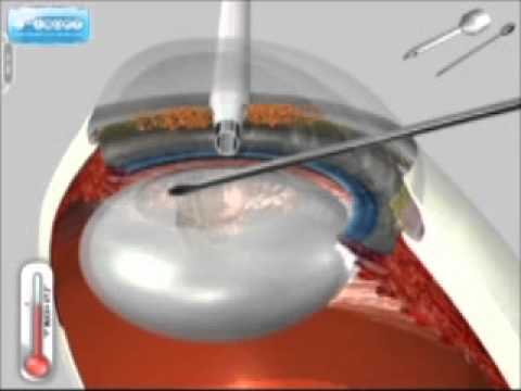intervento laser prostata a vicenza youtube intervento laser prostata a vicenza youtube
