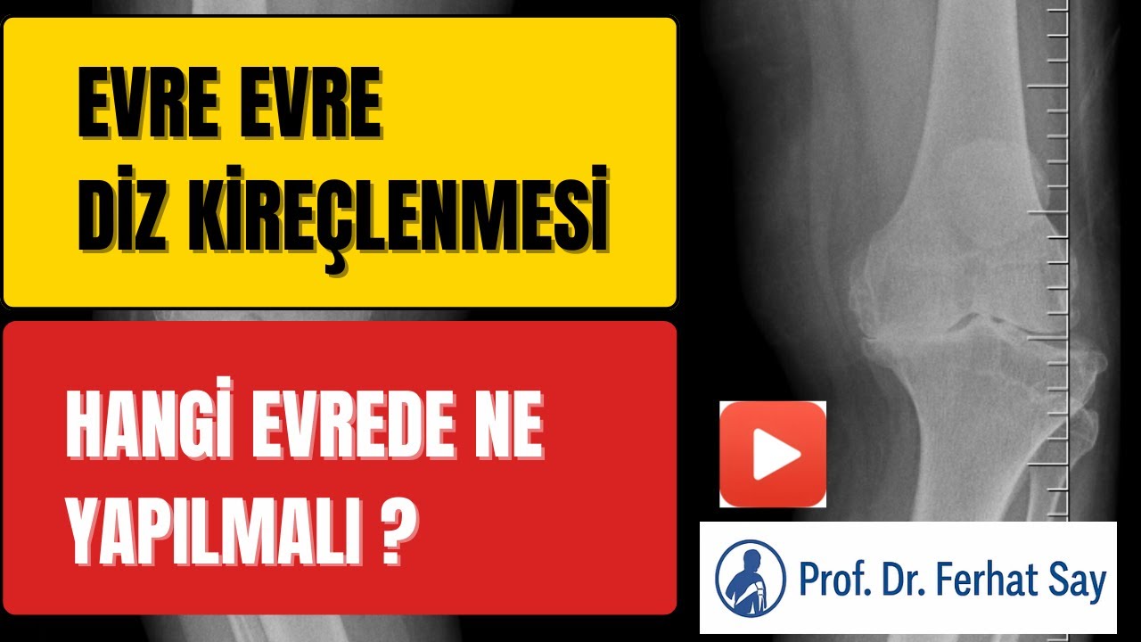 Evre Evre Diz Kireçlenmesi: Hangi Evrede Ne Yapılmalı?