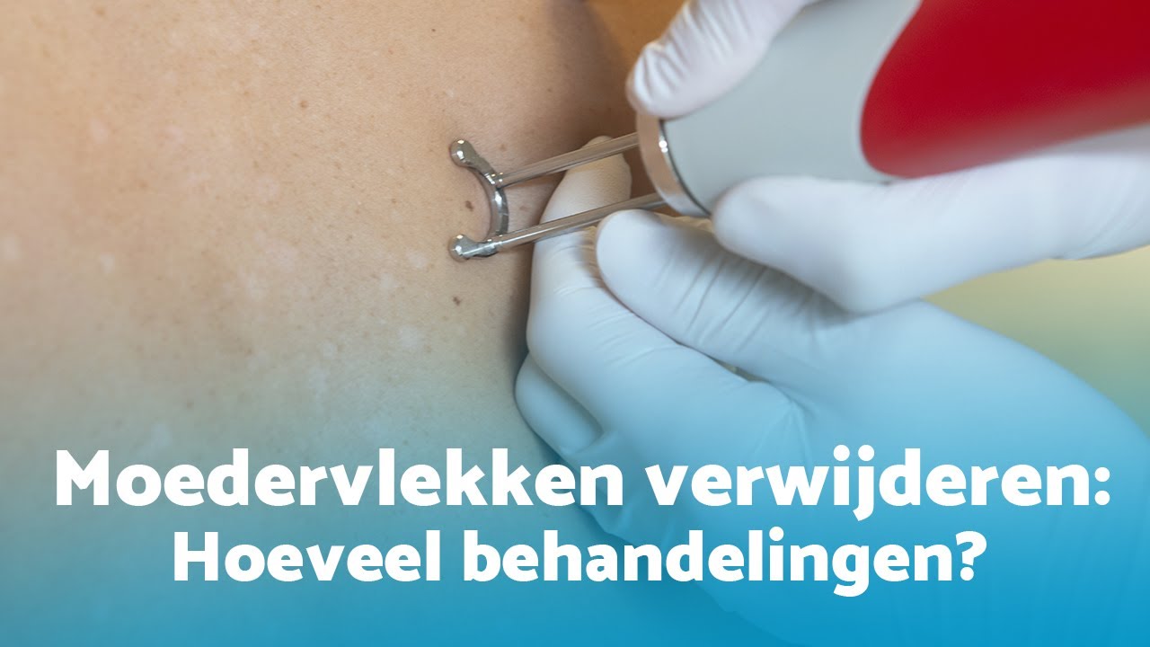 Hoeveel behandelingen zijn er nodig om moedervlekken te verwijderen?