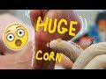 MASSIVE CORN Removal with Callus! Oddly Satisfying!!