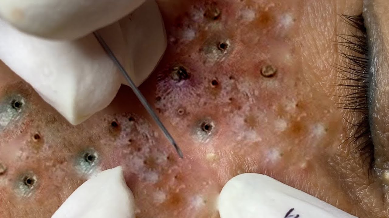 𝐌𝐨𝐬𝐭 𝐒𝐚𝐭𝐢𝐬𝐟𝐲𝐢𝐧𝐠 𝐏𝐢𝐦𝐩𝐥𝐞𝐬 𝐑𝐞𝐦𝐨𝐯𝐚𝐥 𝐀𝐭 𝐇𝐨𝐦𝐞 #1759