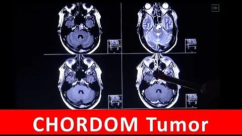 Kann ein Tumor im MRT übersehen werden?