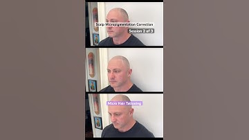 Scalp Micropigmentation session 2 of 3 #smp #scalpmicropigmentation #smptraining #edmonton