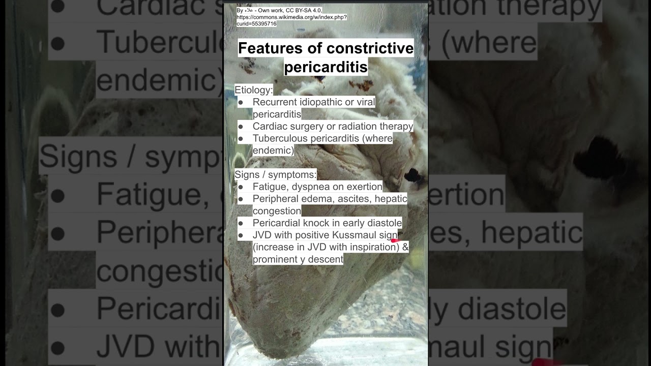 Features of constrictive pericarditis