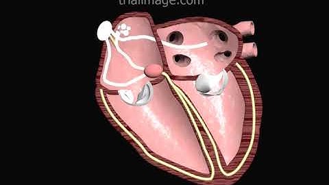 Ectopic Atrial Tachycardia Animation by Cal Shipley, M.D.