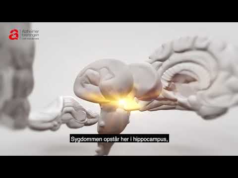 Video: Avancerede Glycations Slutprodukters Rolle I Forskellige Typer Af Neurodegenerativ Sygdom: En Terapeutisk Tilgang