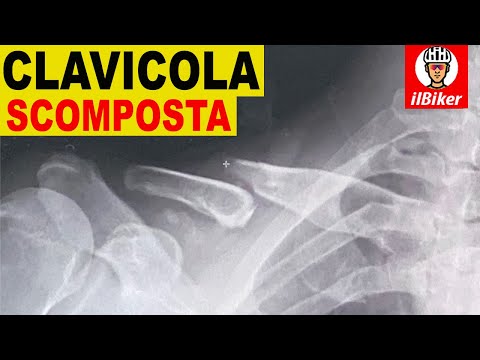 Video: Frattura Della Clavicola Spostata