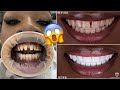 GETTING MY VENEERS DONE IN TURKEY! 🇹🇷 *NO HORSE TEETH* | TRAVEL VLOG